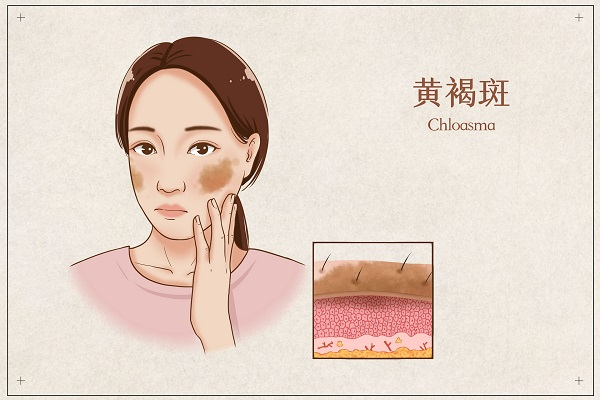 女人肝不好的三大症状,仲景逍遥丸春季养好肝一年少生病